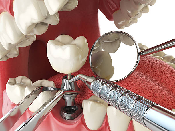 Best Emergency Dentist for Knocked-Out Tooth in Palestine, TX